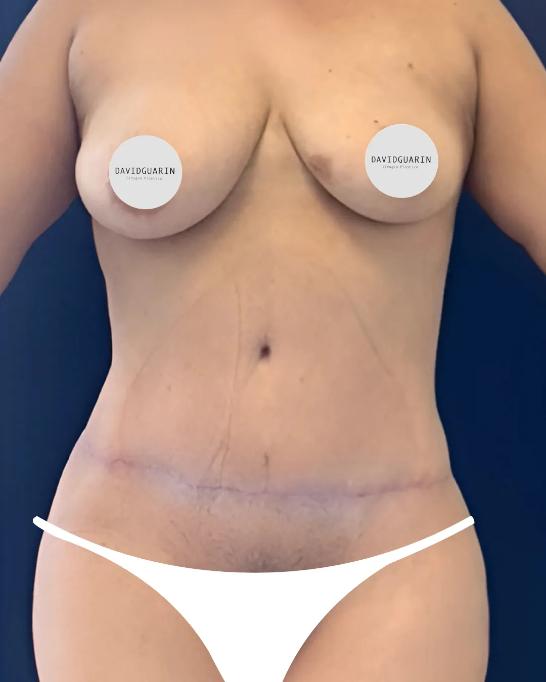 caso de abdominoplastia despues de cirugia