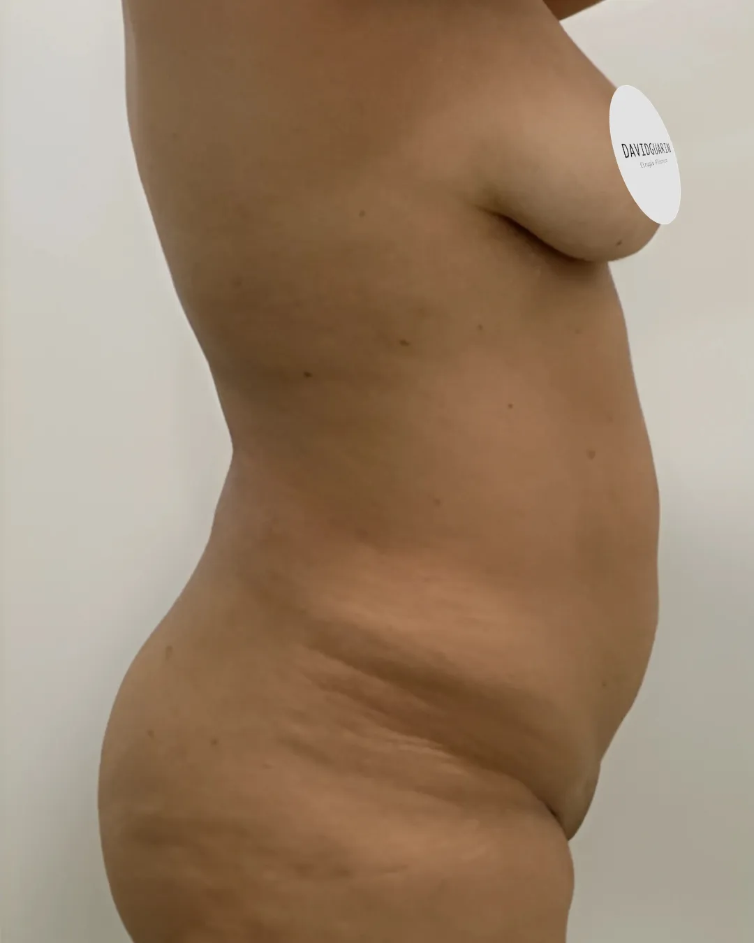 caso de abdominoplastia antes de cirugia