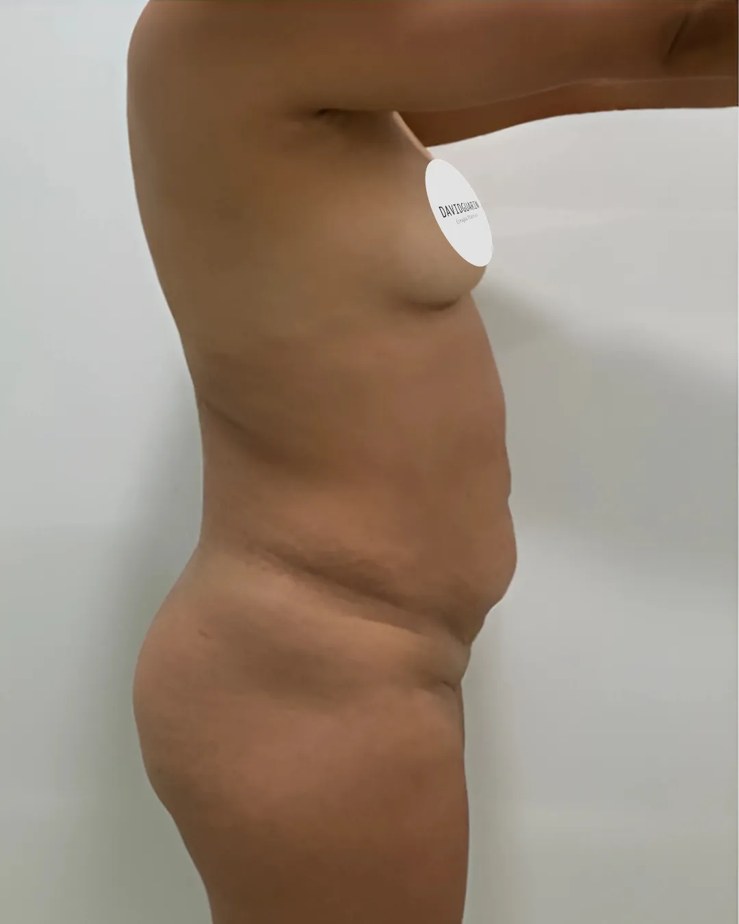 caso de abdominoplastia antes de cirugia 