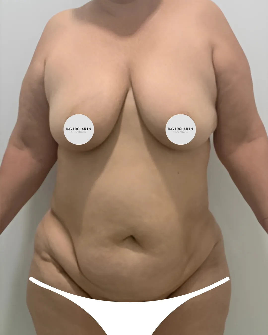caso de abdominoplastia antes de cirugia