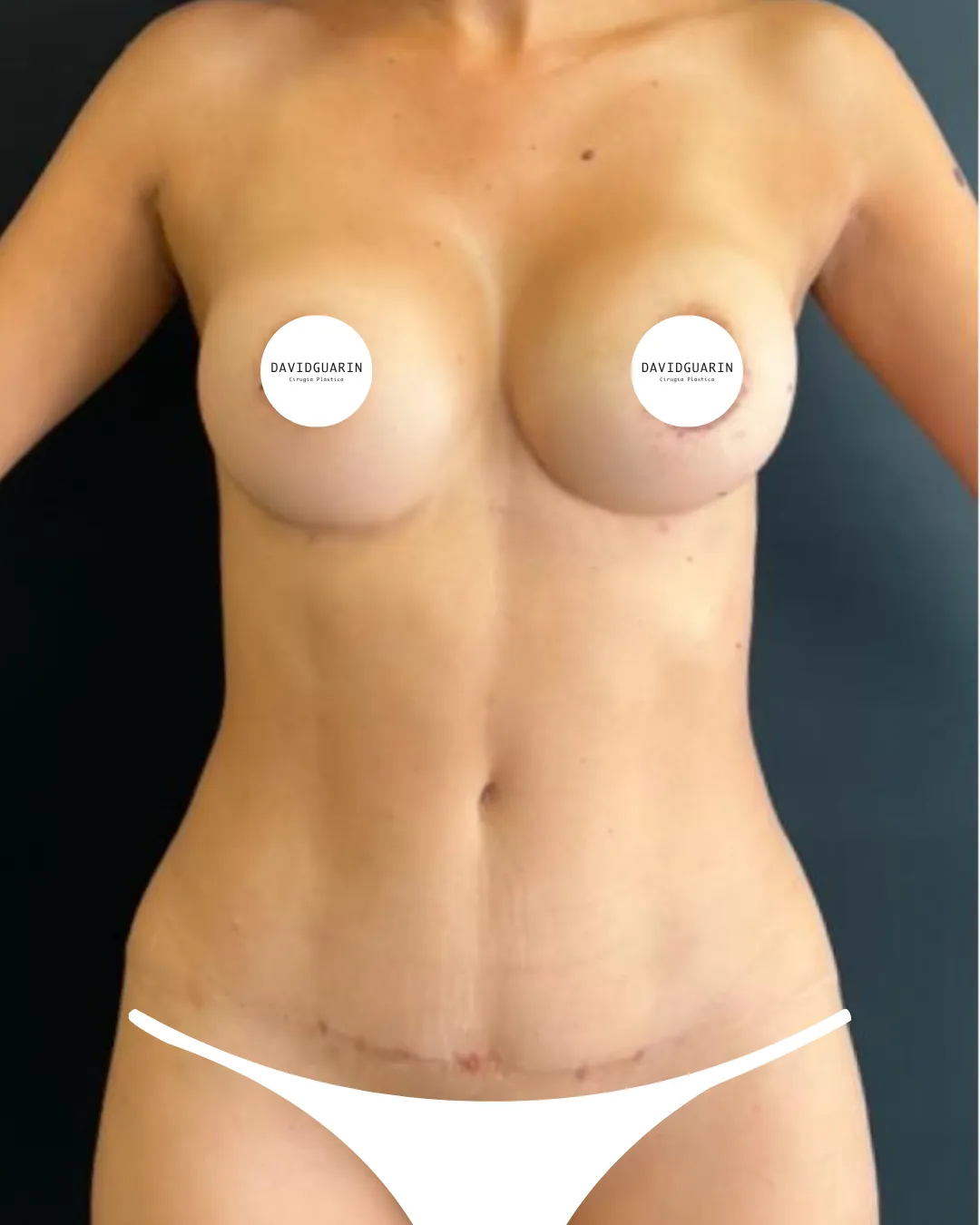 caso de abdominoplastia despues de cirugia
