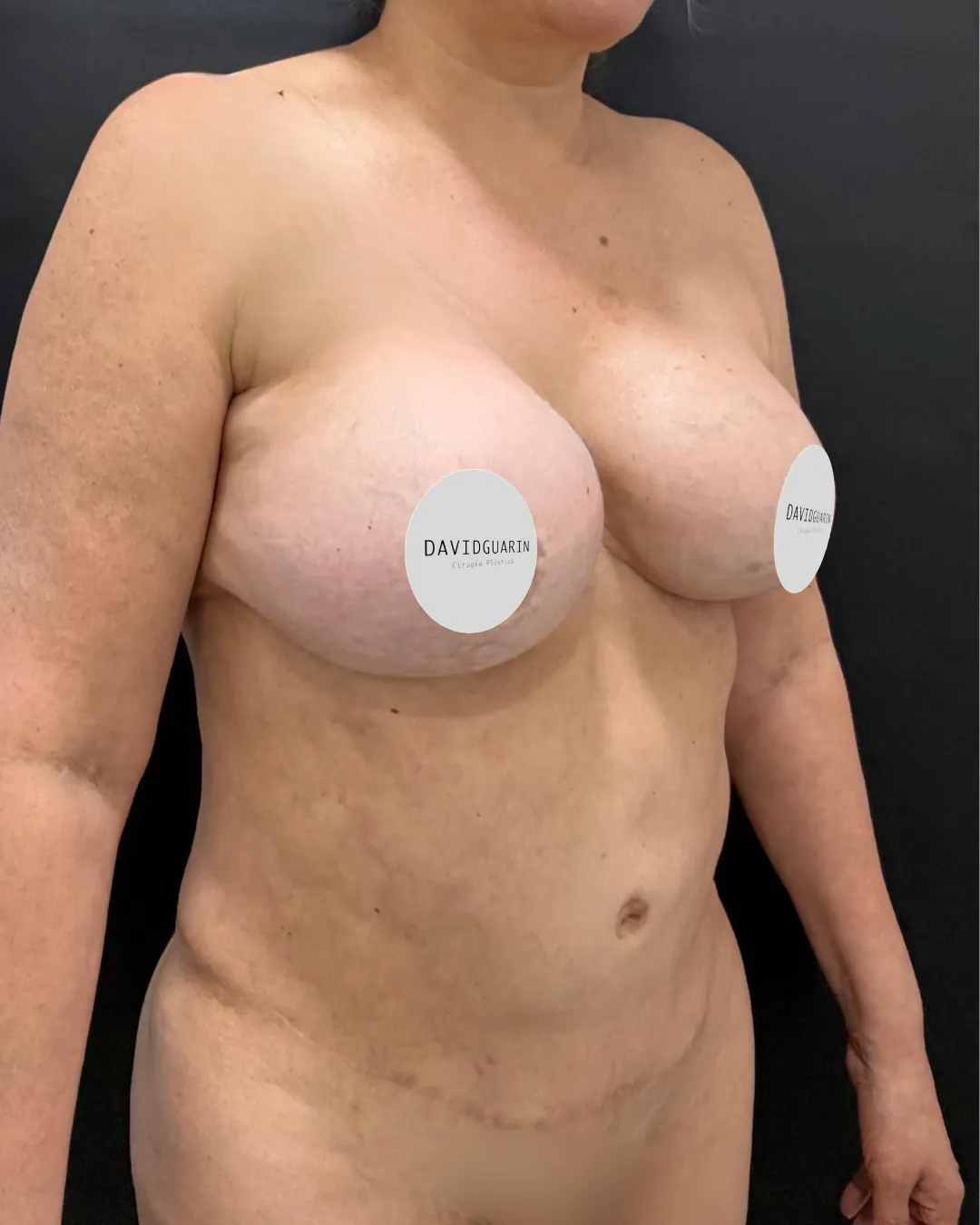caso de abdominoplastia antes de cirugia 