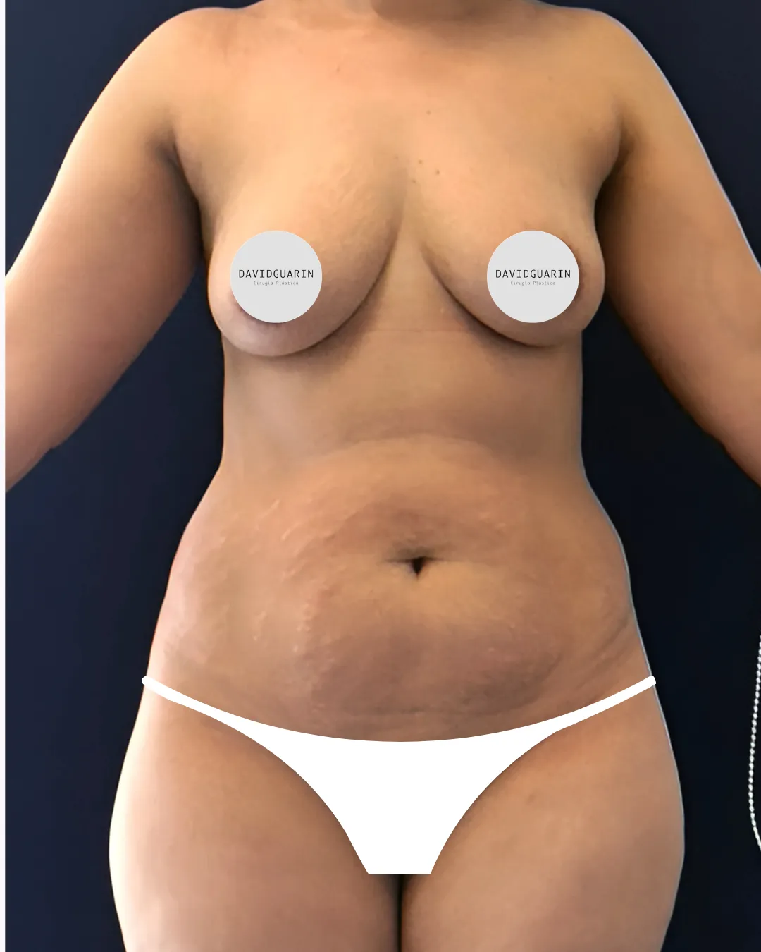 caso de abdominoplastia antes de cirugia