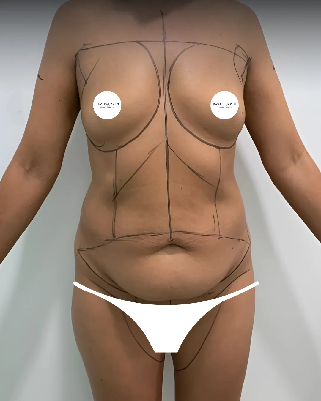 caso de abdominoplastia antes de cirugia