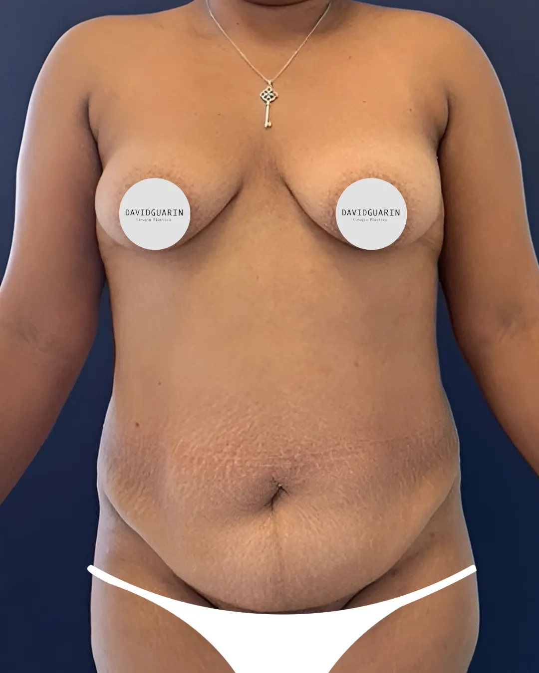 caso de abdominoplastia antes de cirugia