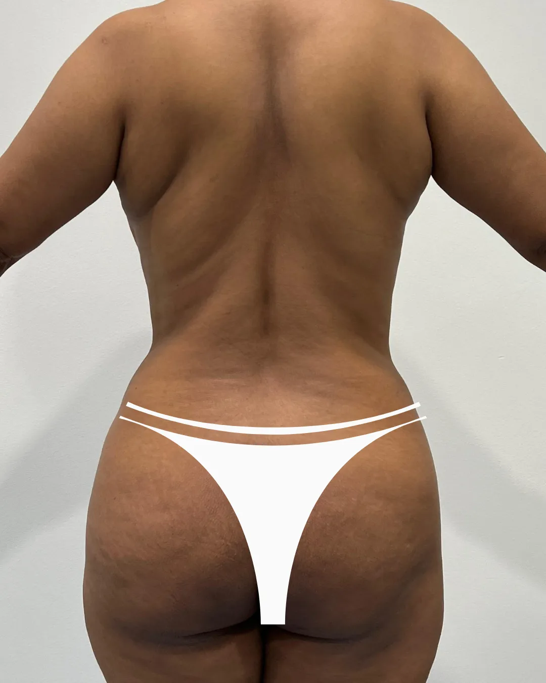 caso de abdominoplastia antes de cirugia