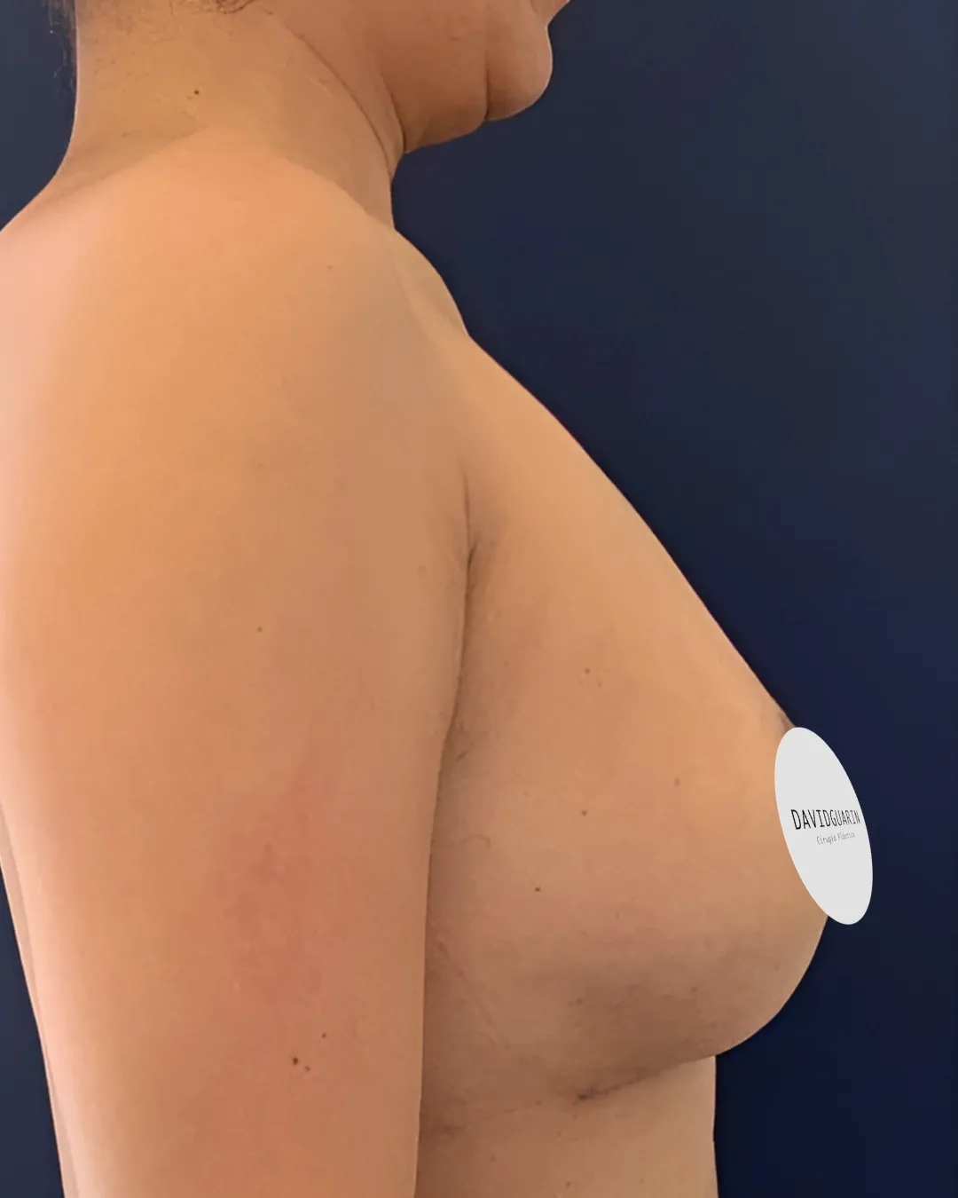caso de explantacion mamaria despues de cirugia