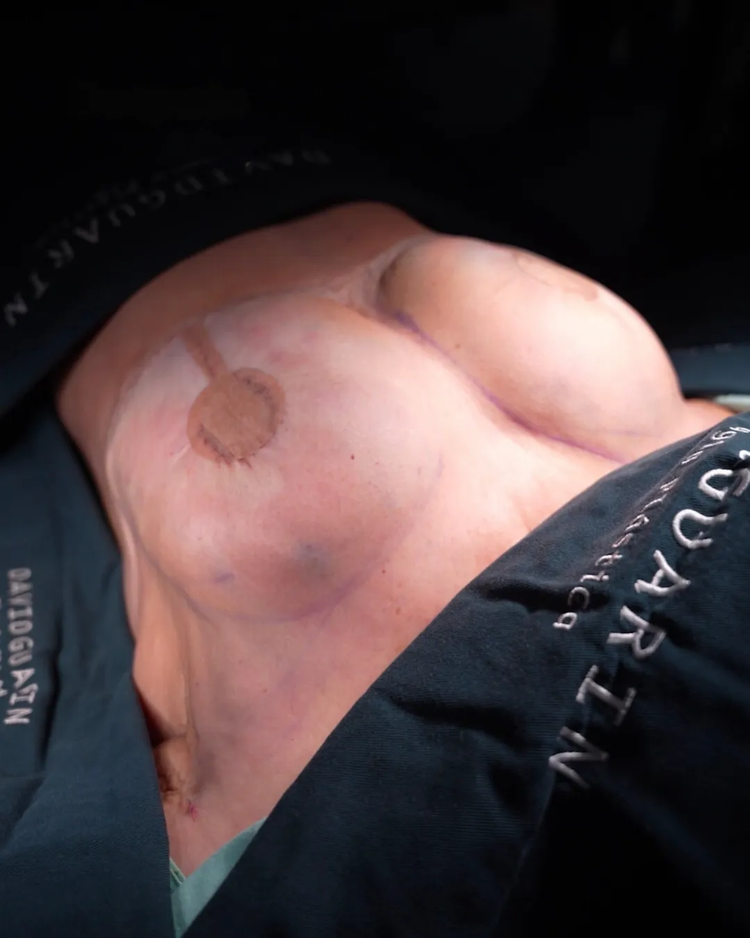 caso de explantacion mamaria despues de cirugia