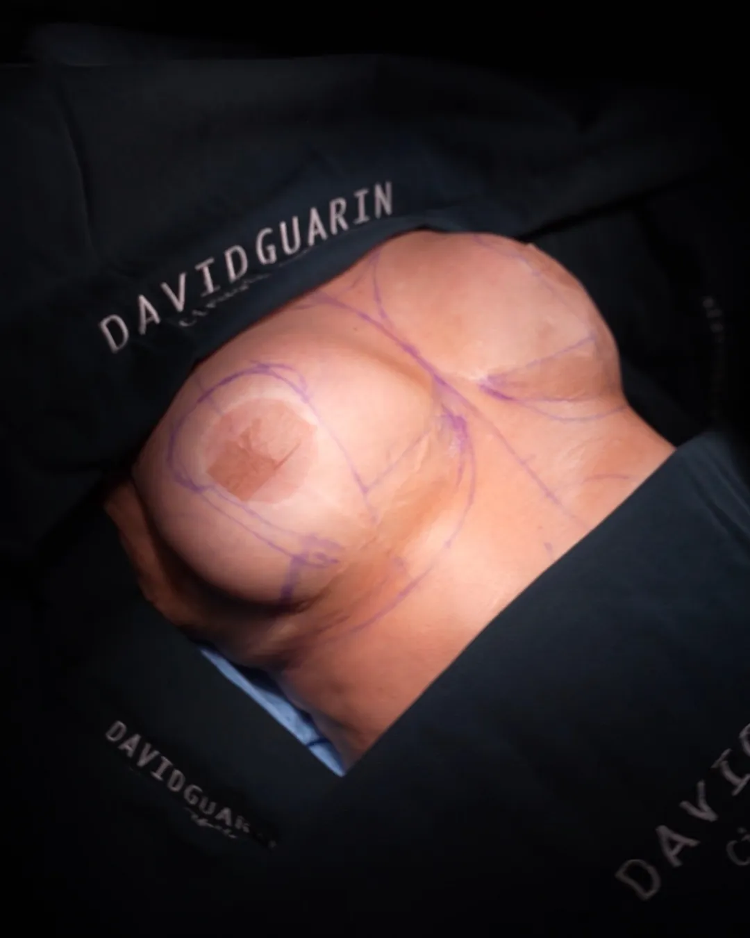 caso de explantacion mamaria antes de cirugia