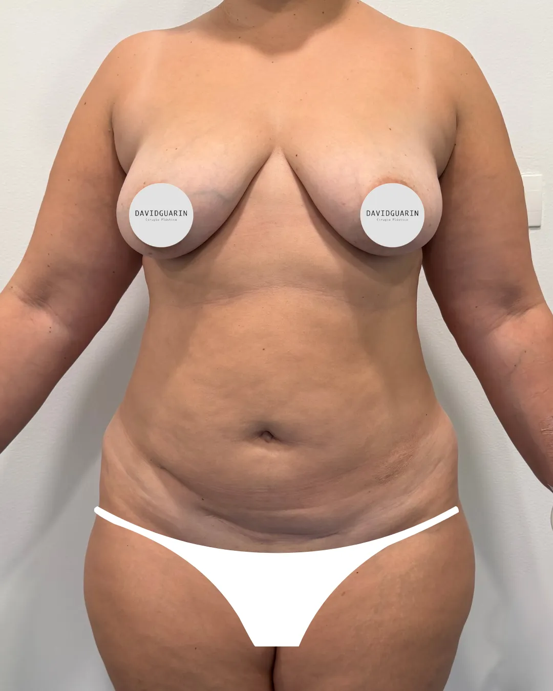caso de Lipoescultura antes de cirugia
