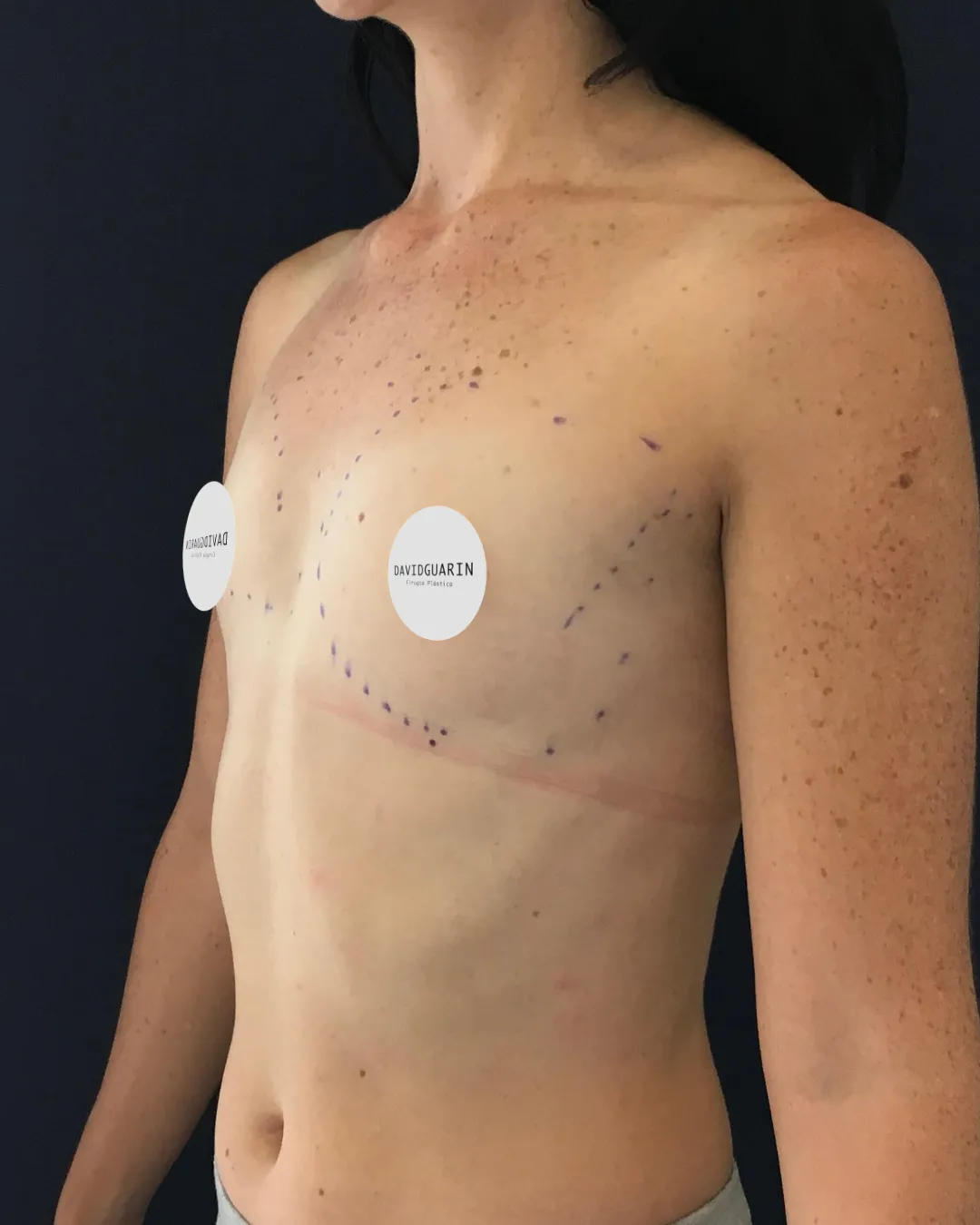 caso de Mamoplastia antes de cirugia