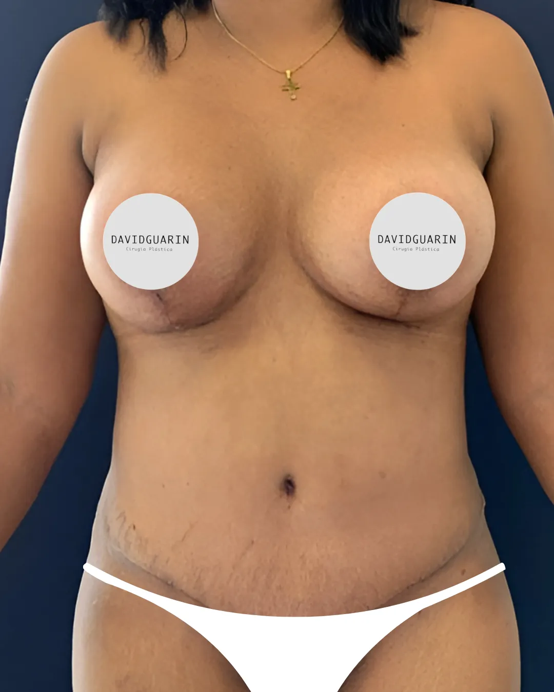 caso de Mamoplastia despues de cirugia