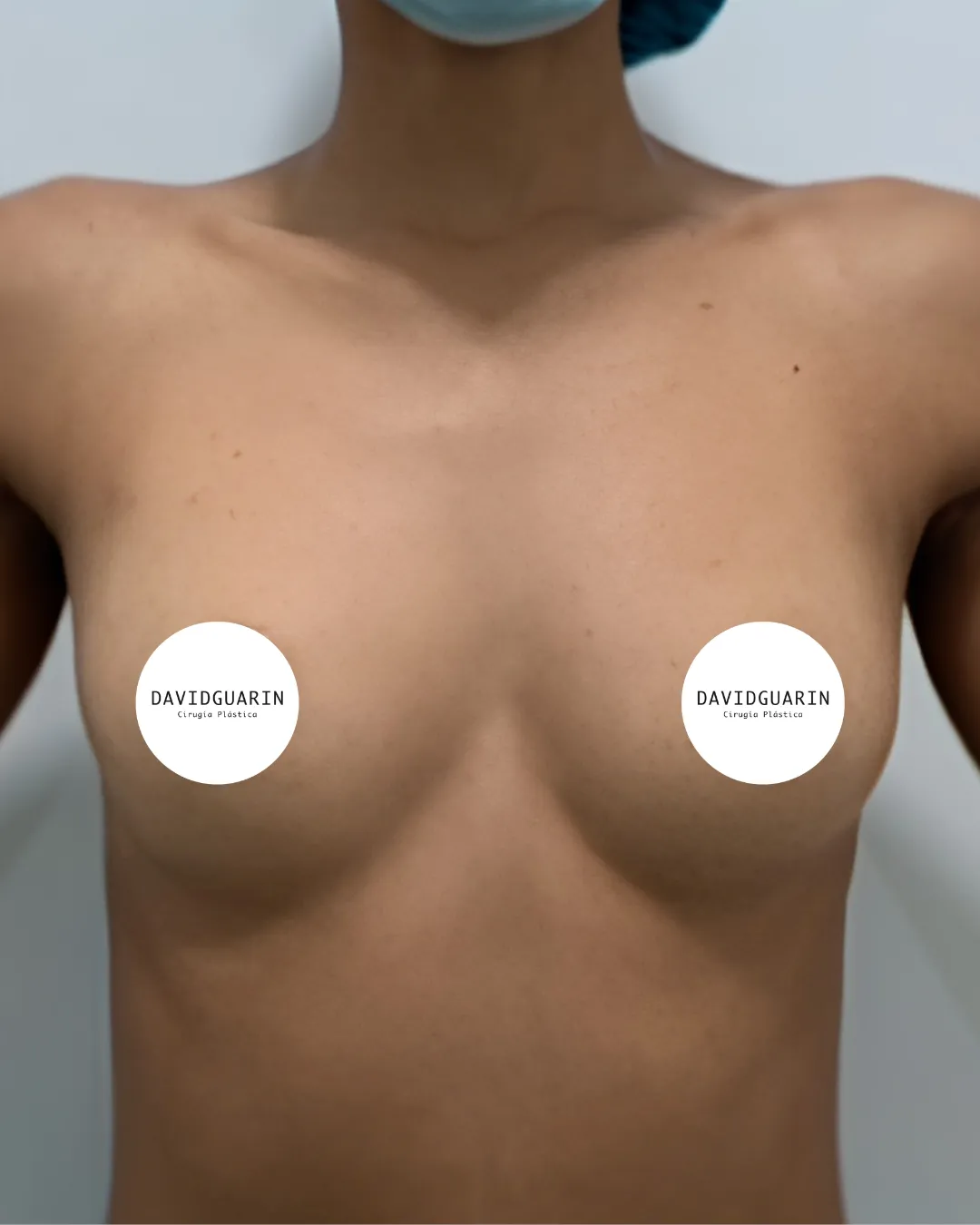 caso de Mamoplastia antes de cirugia 