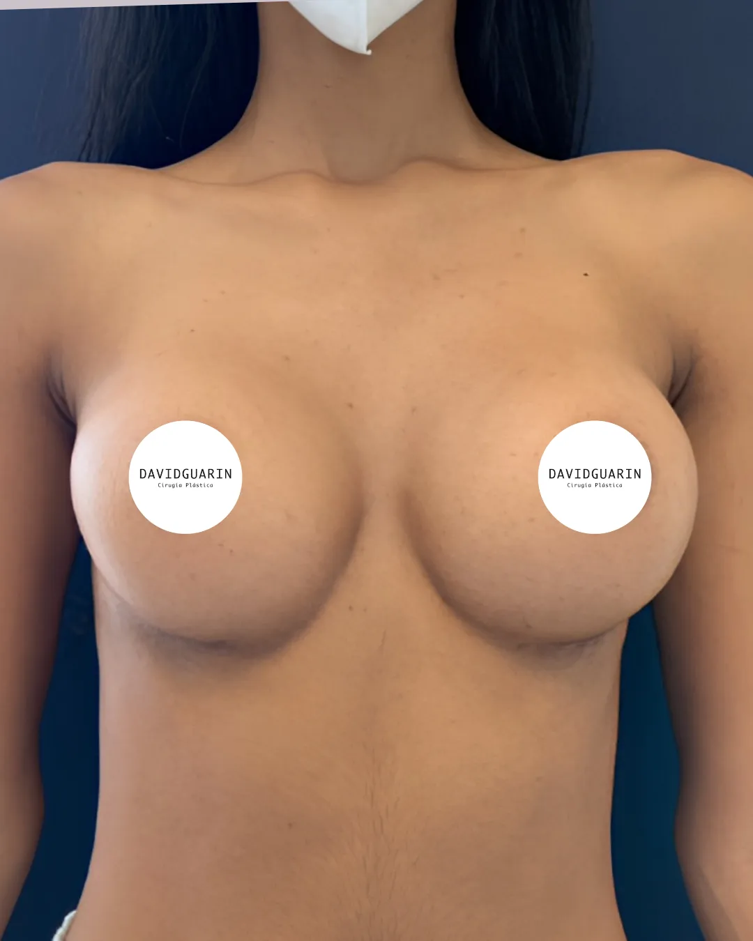 caso de Mamoplastia despues de cirugia