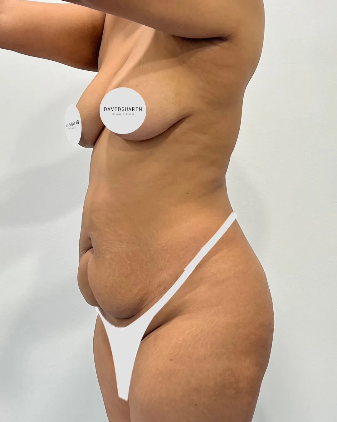 caso de Mommy makeover antes de cirugia