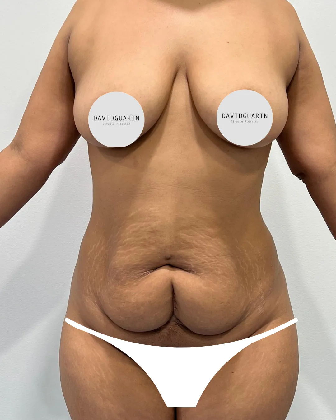 caso de Mommy makeover antes de cirugia  
