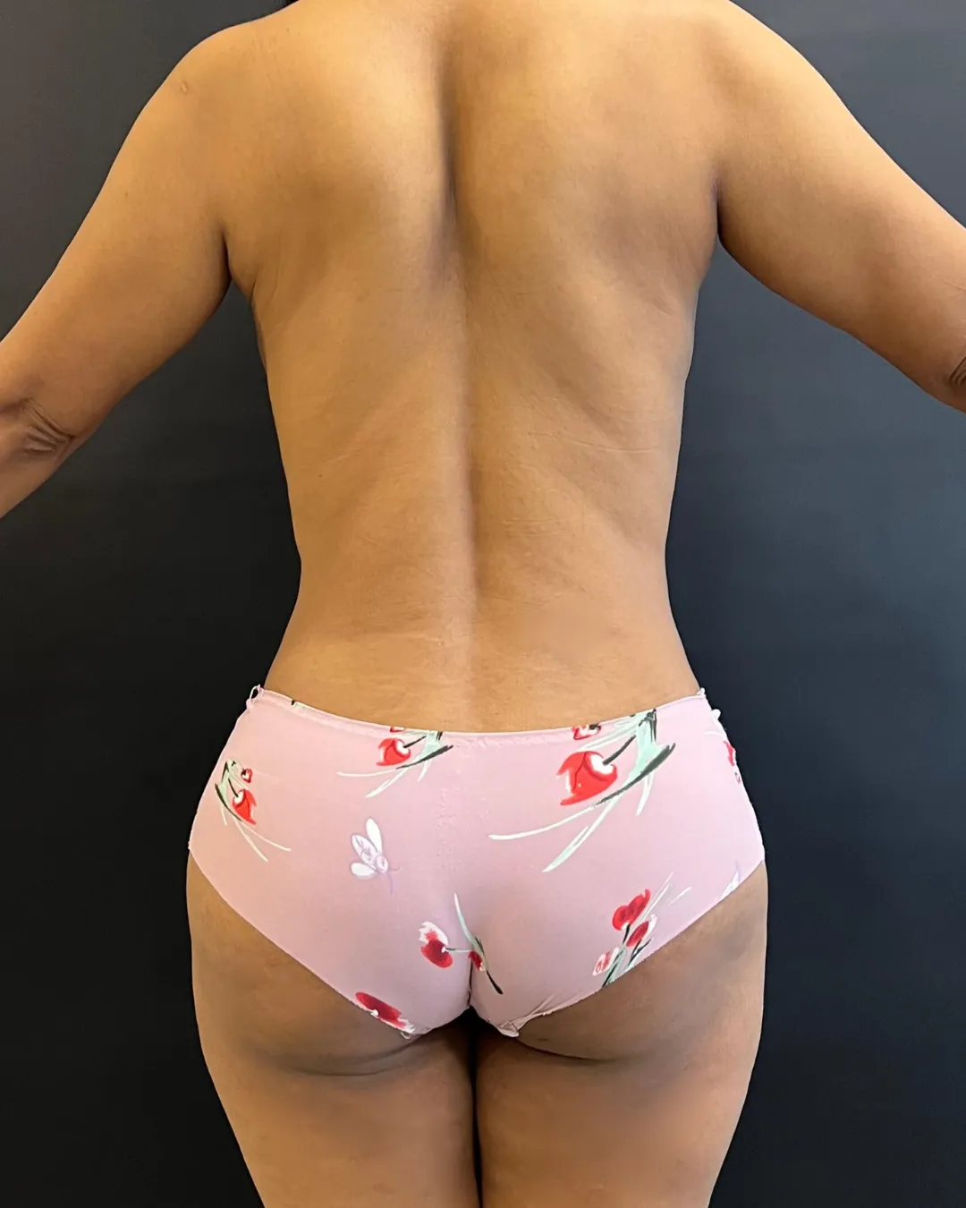 caso de Mommy makeover despues de cirugia