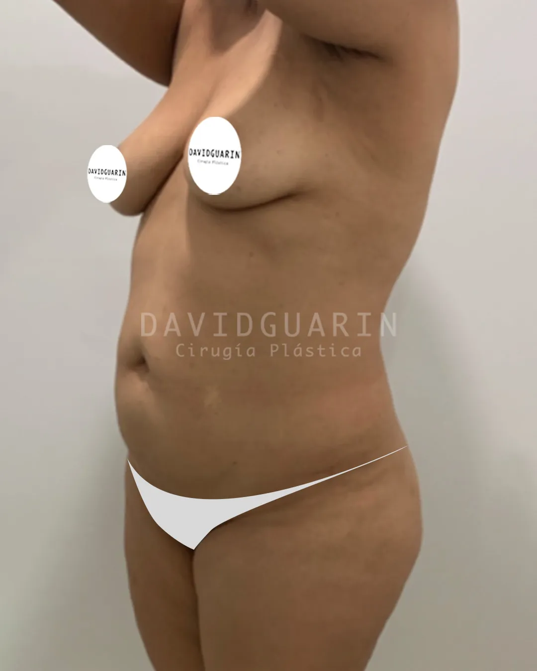caso de Lipoescultura antes de cirugia