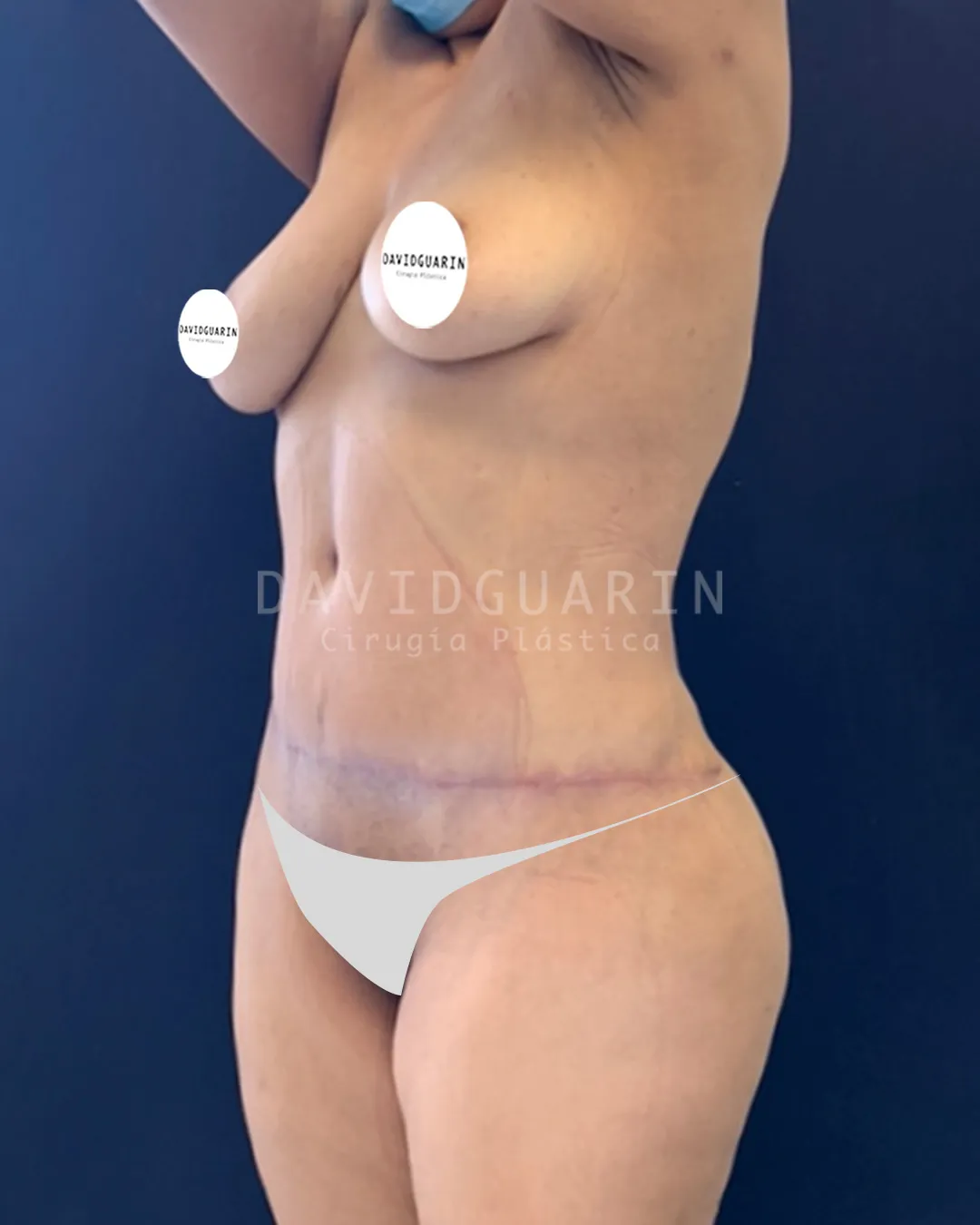 caso de Lipoescultura despues de cirugia