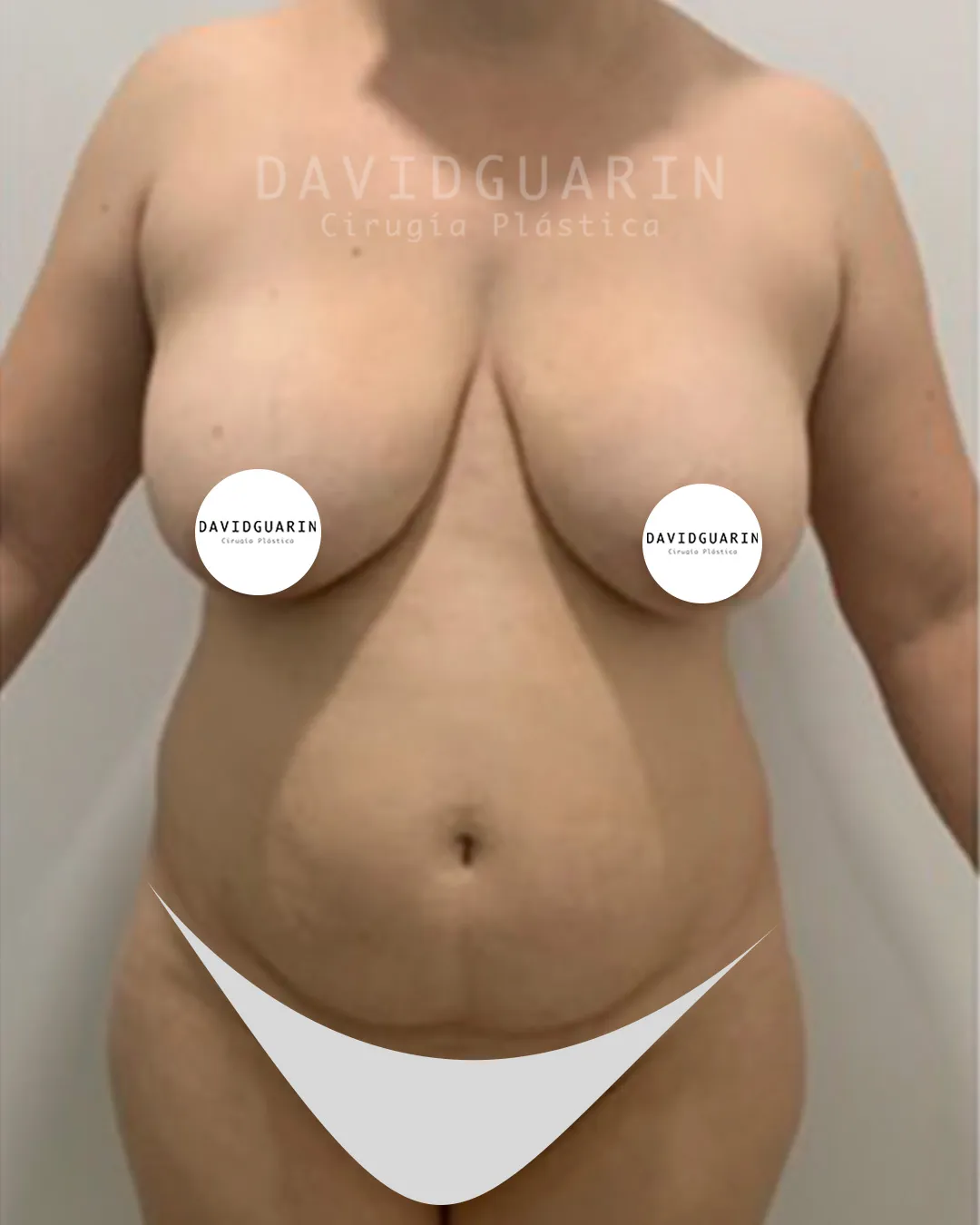 caso de Mommy makeover antes de cirugia