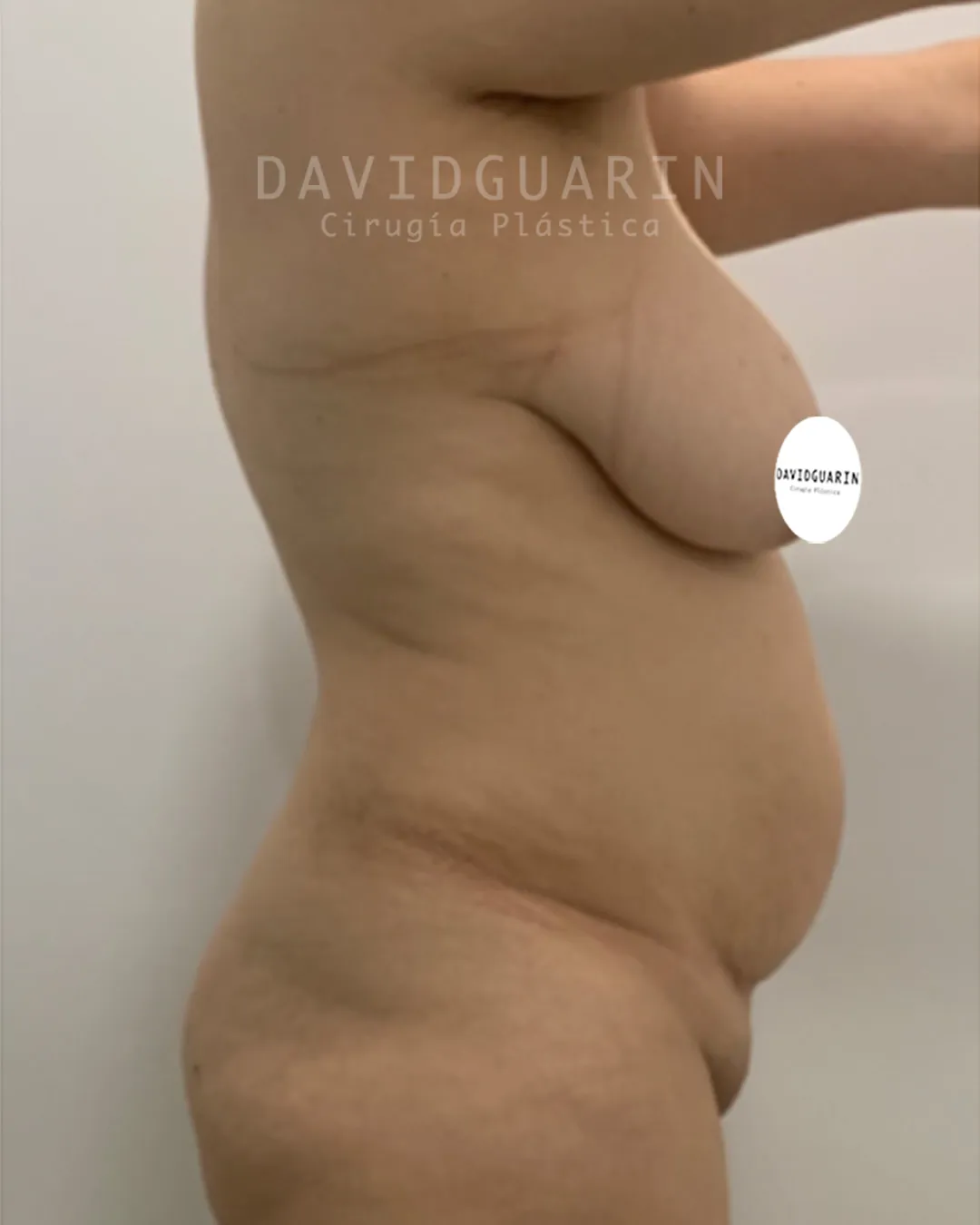 caso de Mommy makeover antes de cirugia  