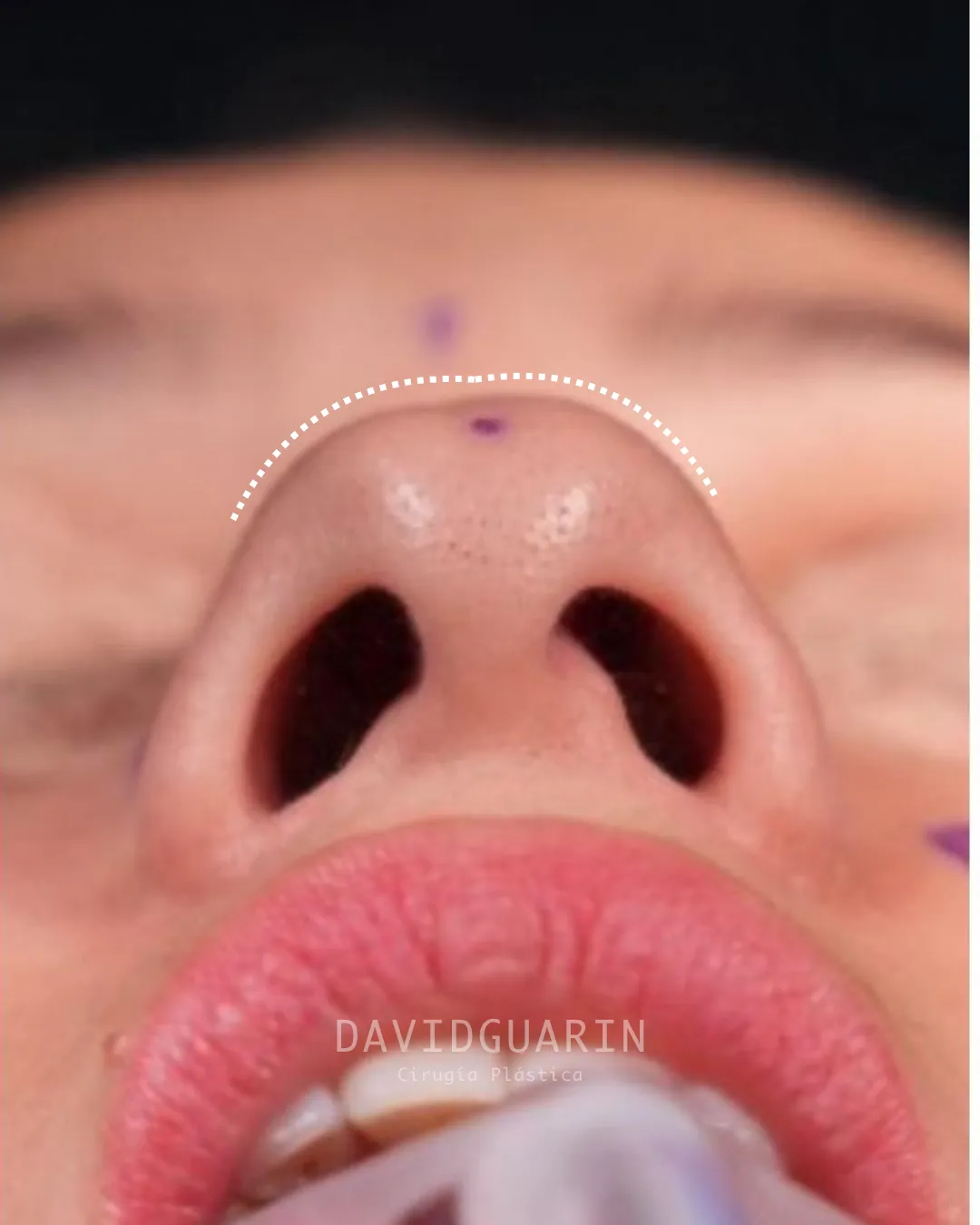 caso de Rinoplastia antes de cirugia