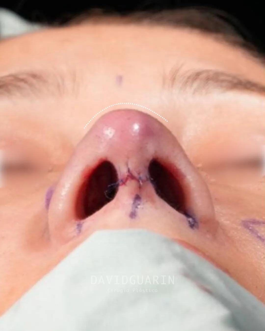 caso de Rinoplastia despues de cirugia