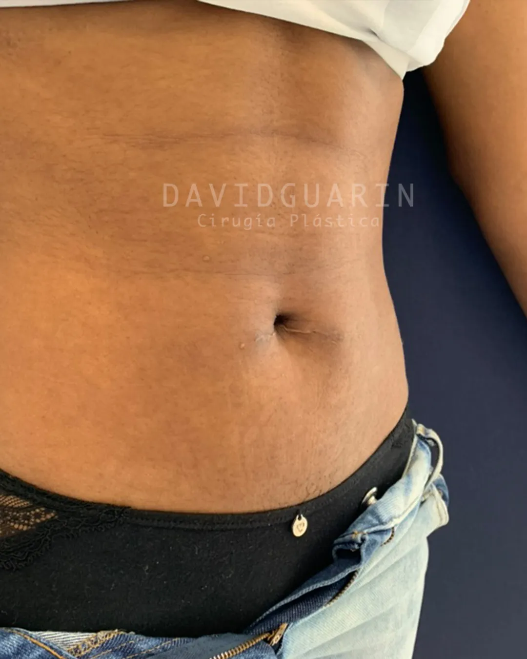 caso de Umbilicoplastia despues de cirugia
