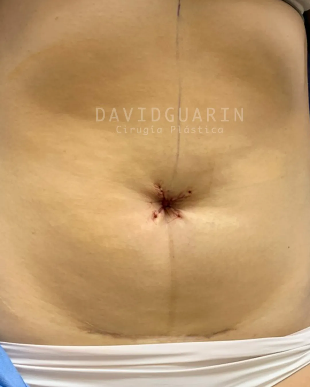 caso de Umbilicoplastia despues de cirugia