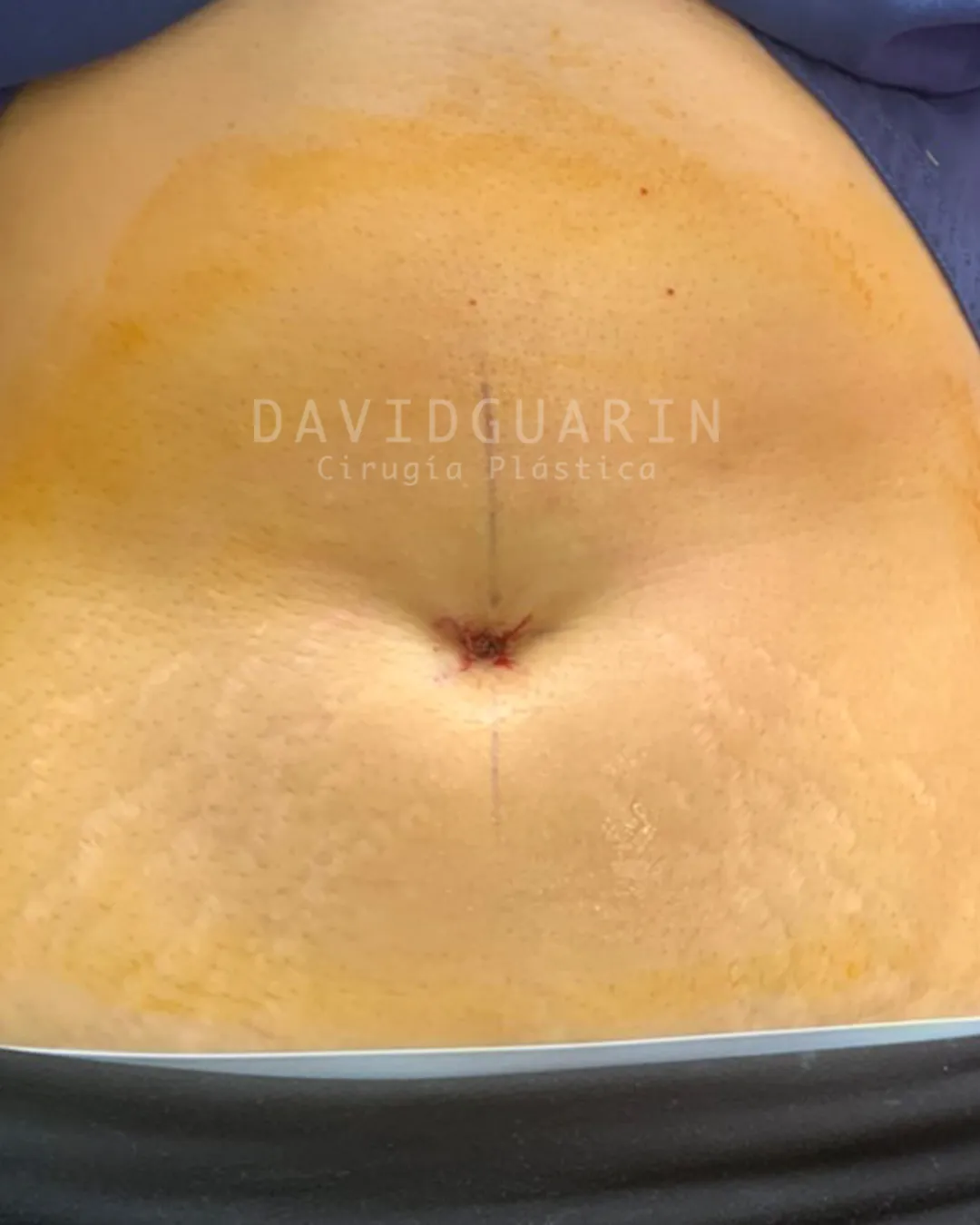 caso de Umbilicoplastia despues de cirugia