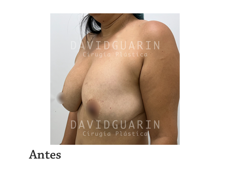 Retiro de implantes mamarios